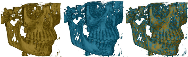 Dual contouring result (left), MC result (middle), and comparisons of both surfaces by superposition for regular datasets of size 64x64x64 of Neghip (top) and Buckyball (second), and of size 256x256x256 (rendered in 1:4) of Bonsai (third) and Skull (bottom). (Datasets available at http://www.volvis.org.)